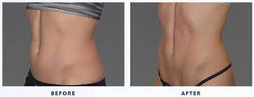Maybe you would like to learn more about one of these? How Much Does Coolsculpting Cost