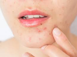 Yes Birth Control Helps Acne Here Are The Best Options