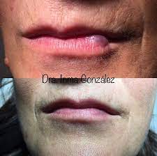 These benign lesions form when blood vessels, called venules, dilate and proliferate. Klaser Blue Red Moles Or Cherry Angiomas Are Common Facebook