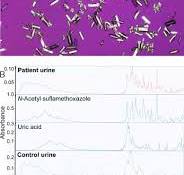 Sulfamethoxazole Crystalluria - American Journal of Kidney ...