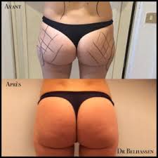 Lipofilling fesses tunisie, augmentation du volume des fessiers par réinjection de graisse autologue. Lipofilling Des Fesses Cabinet Dr Fares Belhassen Chirurgie Esthetique Nice