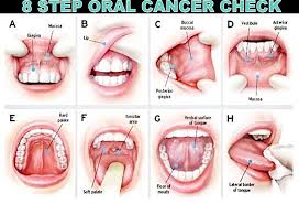 They bleed if bitten or touched. Oral Cancer Month Alexandria Smiles