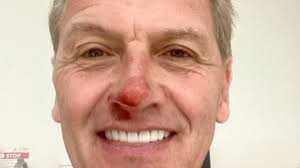 Channel Seven star involved in horror bike crash: 'I've taken a bit of bark  off my face'