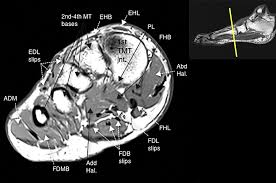 Applications for magnetic resonance imaging (mri) of the foot and ankle figure 8.4 image planes for foot and ankle mri. Https Www Mri Theclinics Com Article S1064 9689 11 00049 3 Pdf