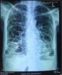Bronkiektasis Dengan Multiple Bula Terinfeksi : Sebuah Laporan Kasus