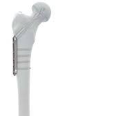 DHS/DCS System | Products | DePuy Synthes