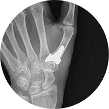 STABLYX® CMC Arthroplasty System - Skeletal Dynamics