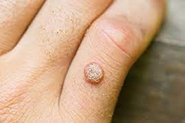 Otherwise, surgical removal is only recommended if warts are very large or growing deep below the skin. Tri Cities Skin Cancer Warts
