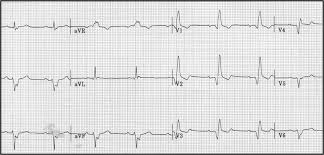 Image result for Q Wave