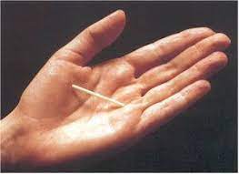 Er enthält das reine gestagenpräparat etonogestrel und ist in der verhütungsweise der minipille vergleichbar. Implanon Dr Med Michael Singer Gyne