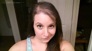 After you have given birth, the excess hair that was not shed during pregnancy will be lost. Damn You Post Partum Shed Photo