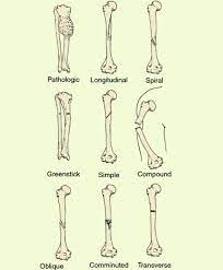 Medical Doctors On Instagram Different Types Of Fractures Closed Fracture Open Fracture Transvers Types Of Fractures Comminuted Fracture Open Fracture