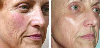 Photo Rejuvenation Led Light Therapy Spring Mist Spa Milton