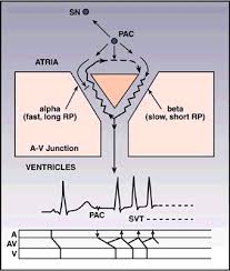 Common psvt mechanisms and corresponding ecg findings. Ecg Learning Center An Introduction To Clinical Electrocardiography