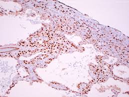 Maybe you would like to learn more about one of these? Pathology Outlines Mesothelioma Versus Adenocarcinoma