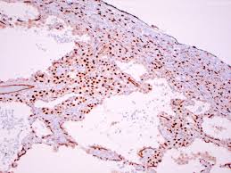 It should not be confused with benign multicystic mesothelioma and benign papillary mesothelioma. Pathology Outlines Mesothelioma Versus Adenocarcinoma