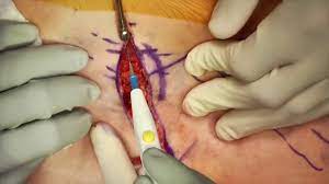 Advertisement from conditions to treatments to surgical devices and more, we've put everything you need to k. Targeted Fascicular Biopsy In A Patient With Prostate Cancer Youtube