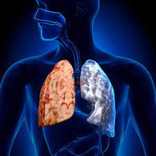 Can You Survive Lung Cancer If Caught Early? | Lung Cancer Lawsuit Lawyers  | Pintas & Mullins Law Firm