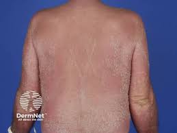 Image result for Generalized Rash