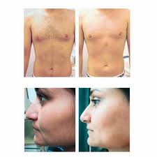We offer a wide variety of leading edge treatments for dermatology issues, from routine to complex. Gentlemax Instagram Posts Photos And Videos Picuki Com