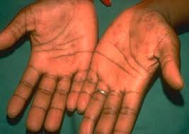 Image result for Secondary Syphilis