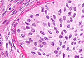 Ovarian Tumors Oncology Medbullets Step 1