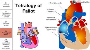 Cyanotic Congenital Heart Diseases Youtube