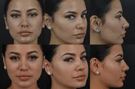 Diary of a nose job. Rhinoplasty Newport Beach Dr Aaron Kosins 949 721 0494