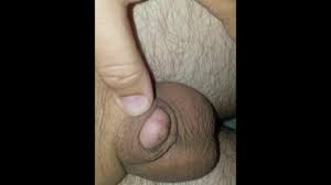 Retracted Micropenis