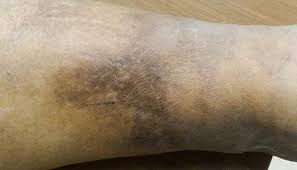 Image result for Cellulitis