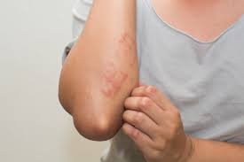 Image result for Atopic eczema atopic dermatitis