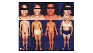 We did not find results for: Scielo Brasil Cardiac Alterations In Patients With Familial Lipodystrophy Cardiac Alterations In Patients With Familial Lipodystrophy