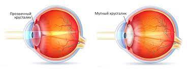 Как защитить свои глаза от катаракты? Katarakta Prichiny Simptomy Metody Lecheniya I Profilaktiki