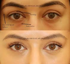 The Spectrum Of Eye Rejuvenation From Injections To Surgery Lara Devgan Md Mph Facs Eye Lift Surgery Mommy Makeover Surgery Eyelid Lift