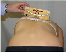 Idiopathic scoliosis progression risk calculator. Measurement Of The Rib Hump Of A Scoliosis Patient In The Forward Download Scientific Diagram