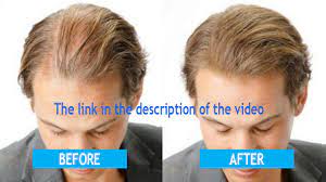 To understand how they work (and hair loss is not necessarily an abnormal thing. Thicken Hair Men Youtube