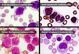 Leukemia is the neoplastic proliferation of hematopoietic precursor cells. Leukemia Blood Cancer Symptoms Types Treatment Survival Rate