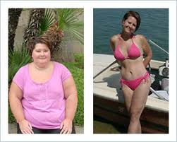 Gastric Sleeve In Indianapolis Surgeons Costs Insurance Stats Bariatric Surgery Source