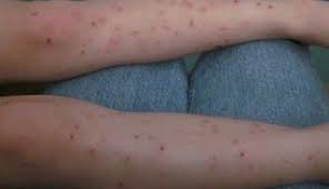 Maybe you would like to learn more about one of these? Vegmom Moments The Chiggers Update