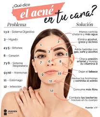 Imagen Radio El Molesto Acne En Tu Cara Te Puede Facebook