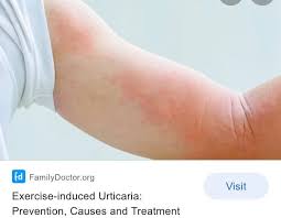Image result for Exercise-Induced Anaphylaxis