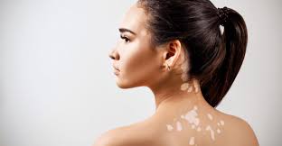 I didn't want to wait until i was completely bald before i did something, so i started using rogaine (minoxidil). Vitiligo Treatment Gold Skin Care Center Dr Michael Gold