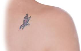 Surgical tattoo removal is preferred over laser tattoo removal by people who wish to avoid several painful laser sessions or just want an. Sugical Tattoo Removal Sudbury Barr Plastic Surgery Sudbury Ontario