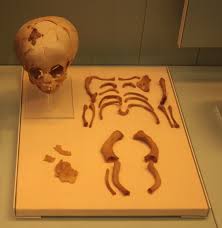 Two Interesting Paleopathology Case Studies Archaeological Discoveries Archaeology Case Study