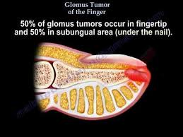 glomus tumor of the finger everything