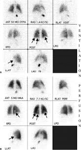 Image result for Ventilation Perfusion Scan