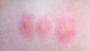 Bug Bites That Look Like Mosquito Bites But Hurt Identifying Common Insect Bites And Stings Sentinel Blog