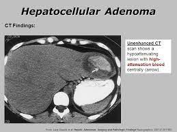 Unenhanced Ct Scan Meaning Ct Scan Machine
