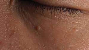 Image result for Skin Tag