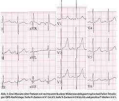 Bei einer herzmuskelentzündung können die eigentlichen herzmuskelzellen, gefäße , häufig aber auch der herzbeutel (perikard) betroffen sein. Ekg Interpretation Was Ist Bei Kindern Anders Doctors Today